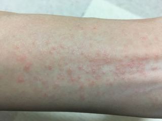 フケと湿疹の原因